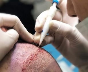 DHI Choi Hair Transplantation - Neohair