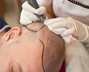 Neograft Hair Transplant surgery photo01