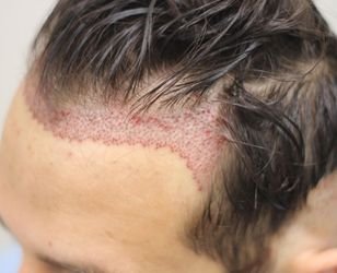 Unshaven Hair Fue Hair Transplant - Neohair