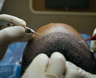 FUE  Hair Transplant surgery photo01