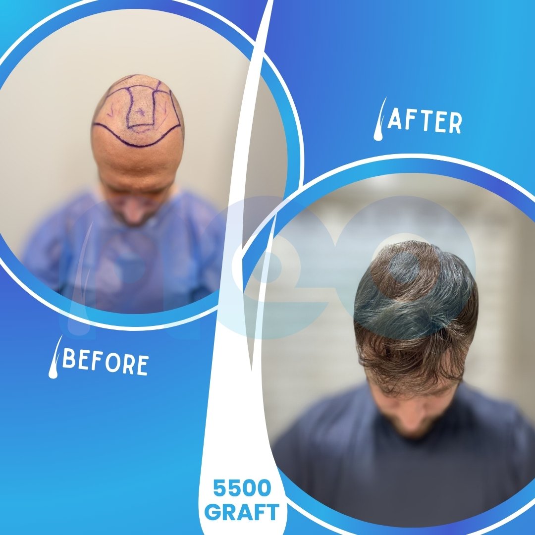 Samuel's Hair Transplant Turkey Journey with before and after