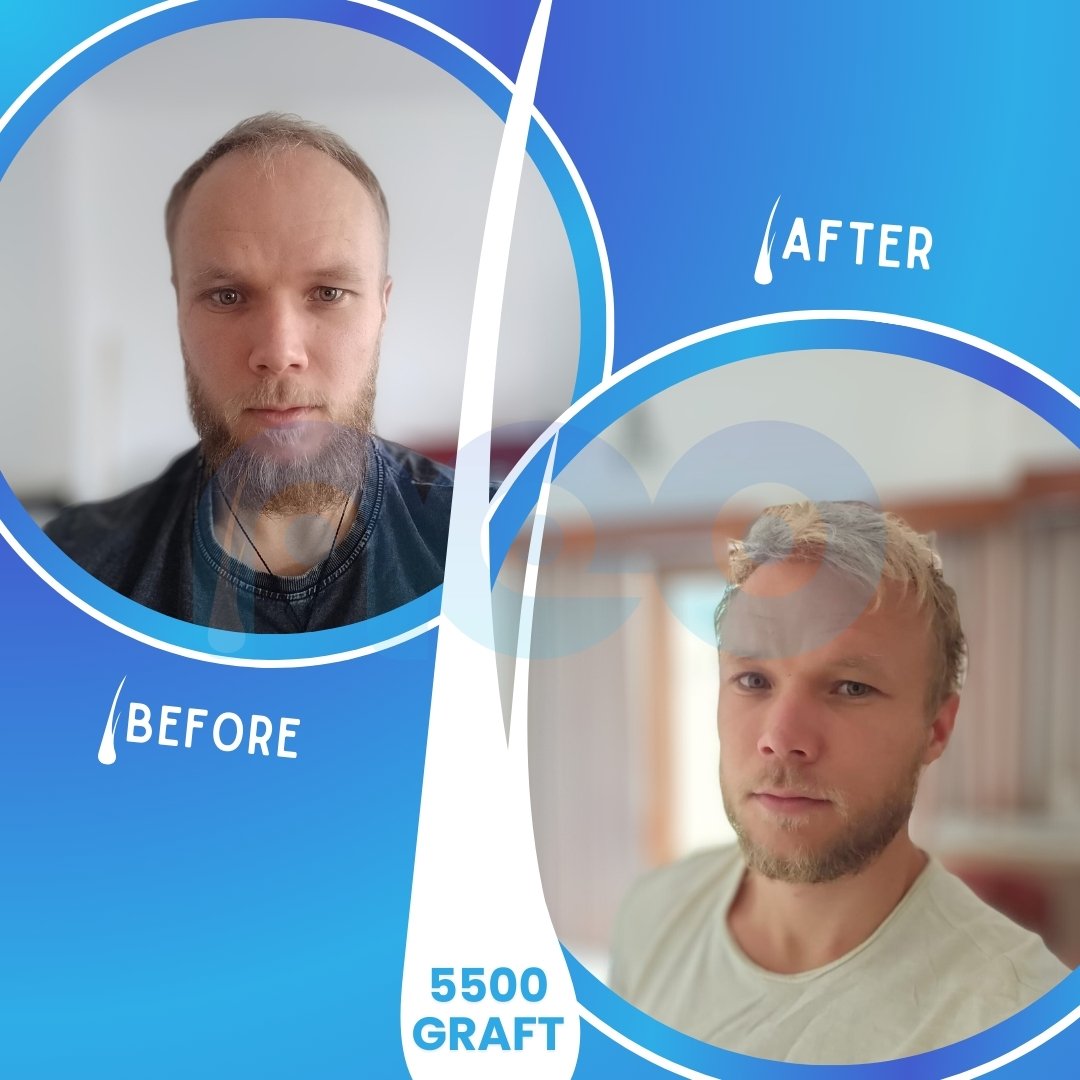 Bartek's Hair Transplant Turkey Journey with before and after