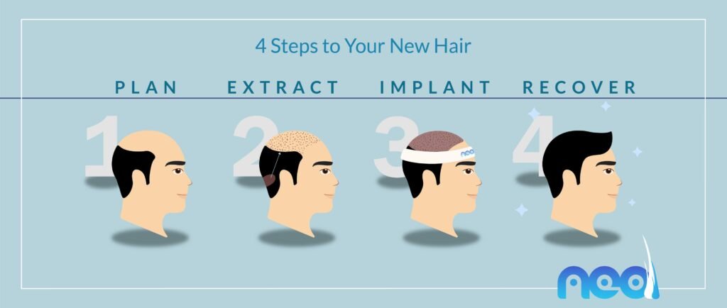 4 Step of Fue Hair Transplant Turkey