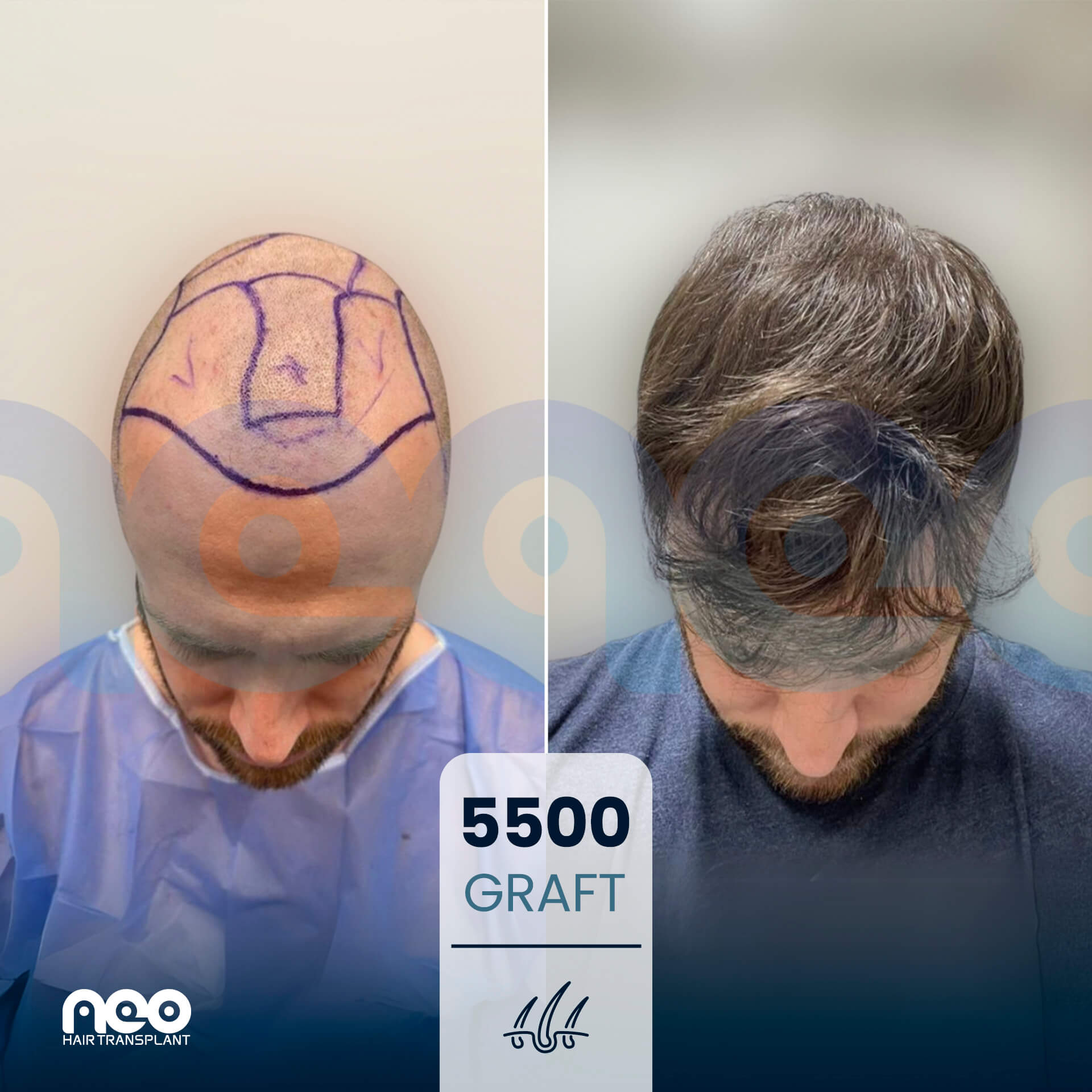 NEO patient hair transplant before and after comparison 4 NEO patient hair transplant before and after comparison 4