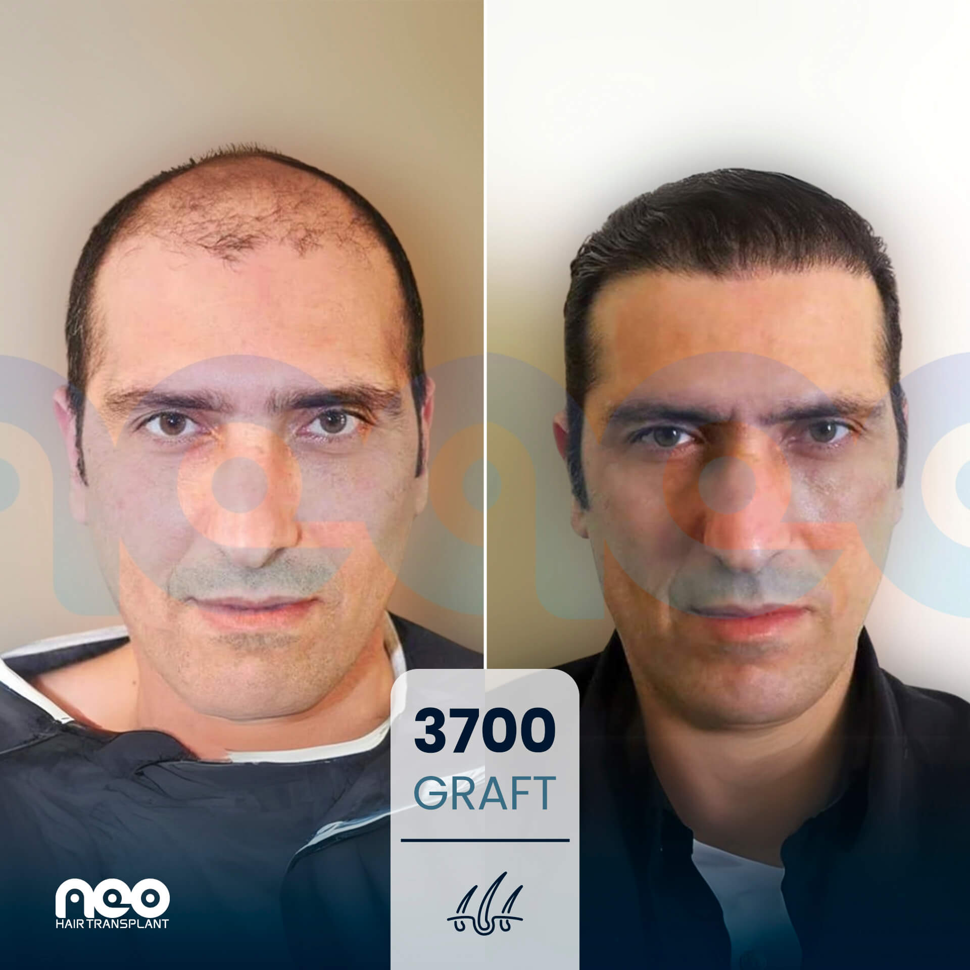NEO patient hair transplant before and after comparison 10 NEO patient hair transplant before and after comparison 10