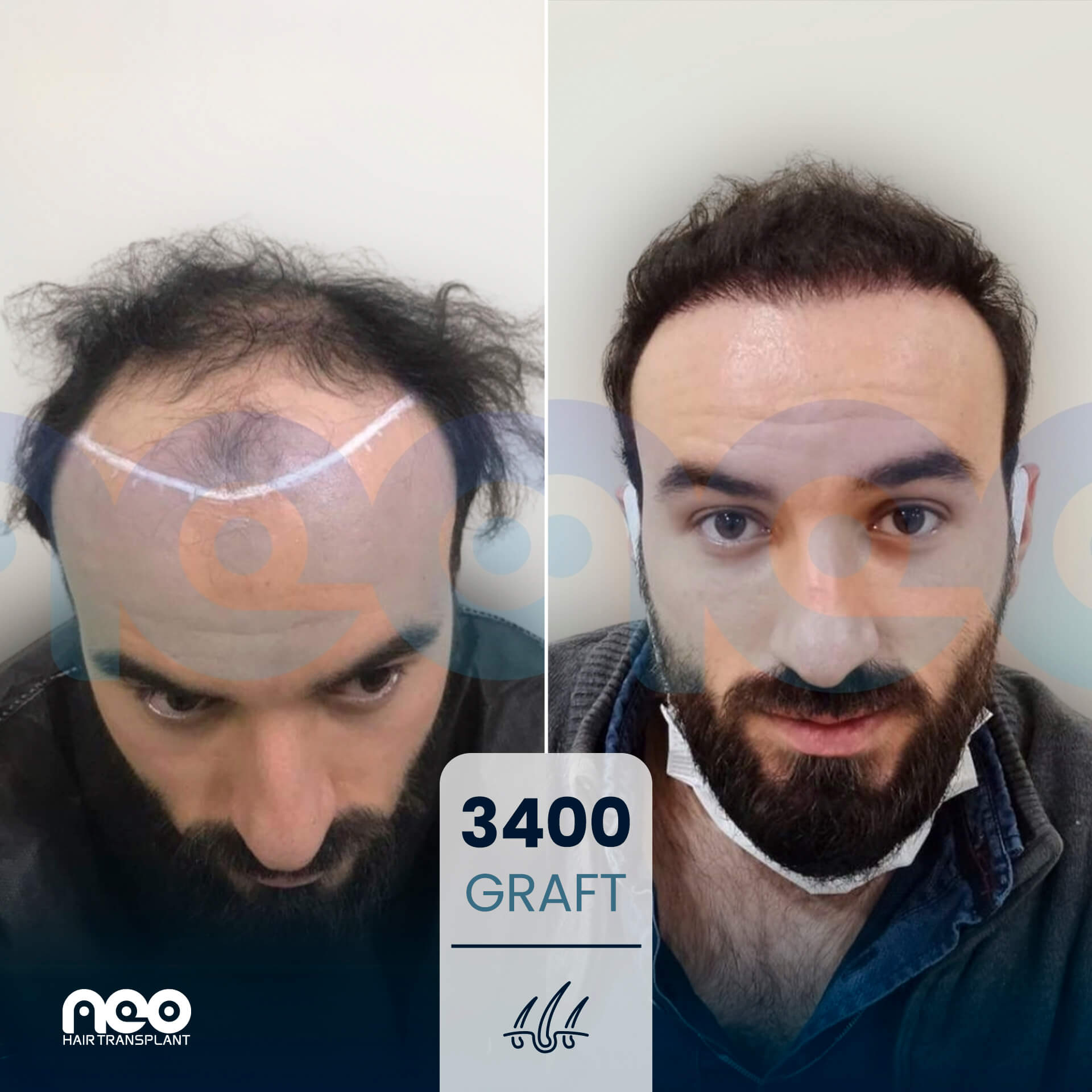 NEO patient hair transplant before and after comparison 9 NEO patient hair transplant before and after comparison 9