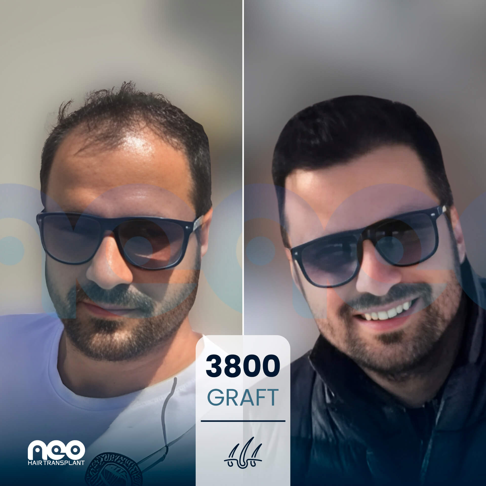 NEO patient hair transplant before and after comparison 5 NEO patient hair transplant before and after comparison 5