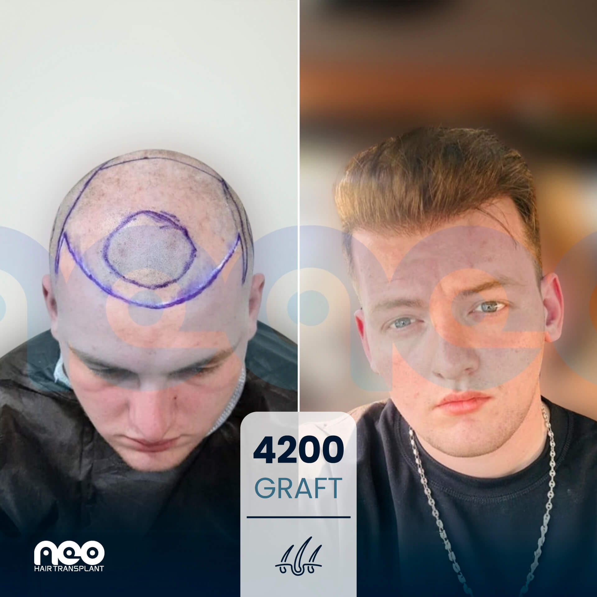 NEO patient hair transplant before and after comparison 3 NEO patient hair transplant before and after comparison 3