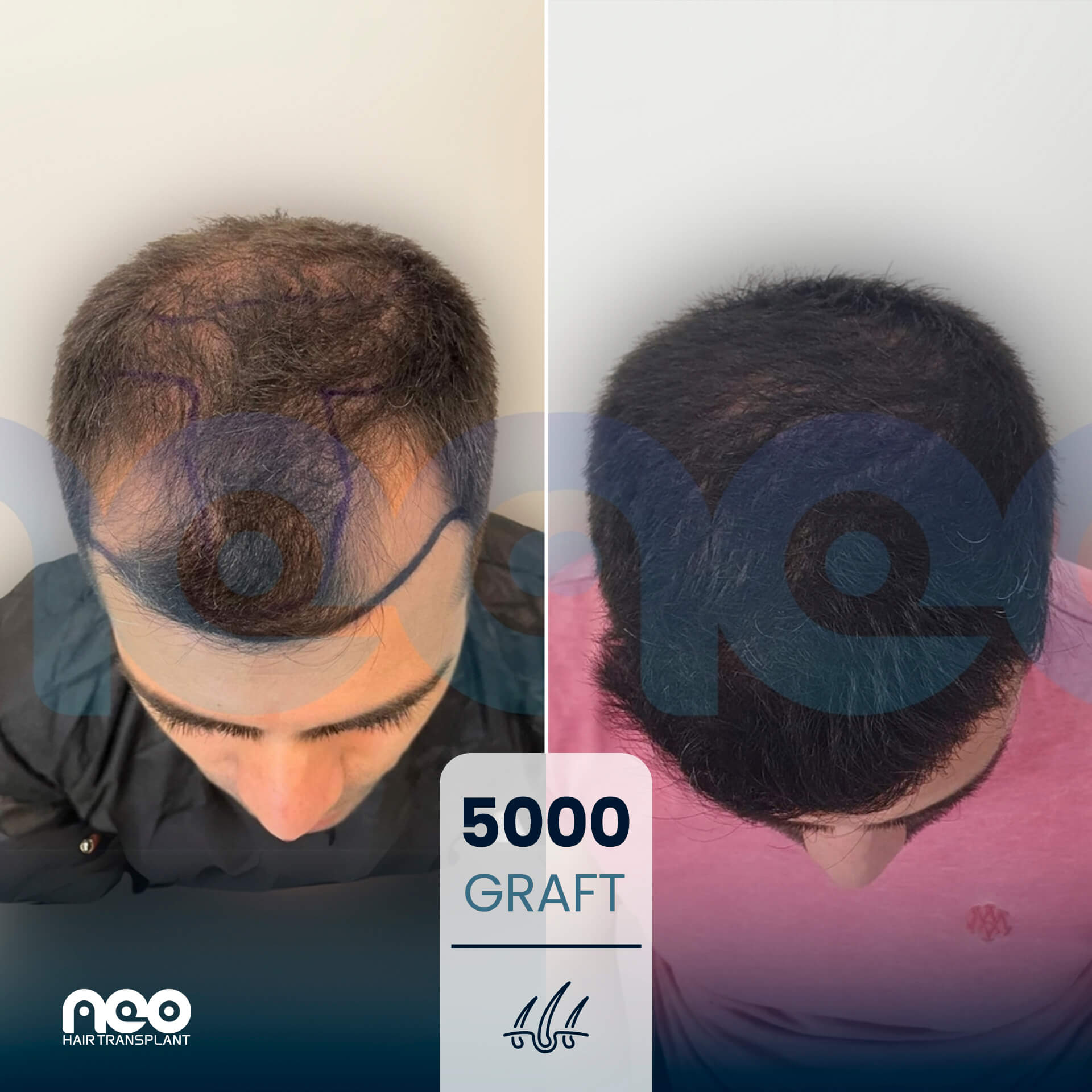 NEO patient hair transplant before and after comparison 7 NEO patient hair transplant before and after comparison 7