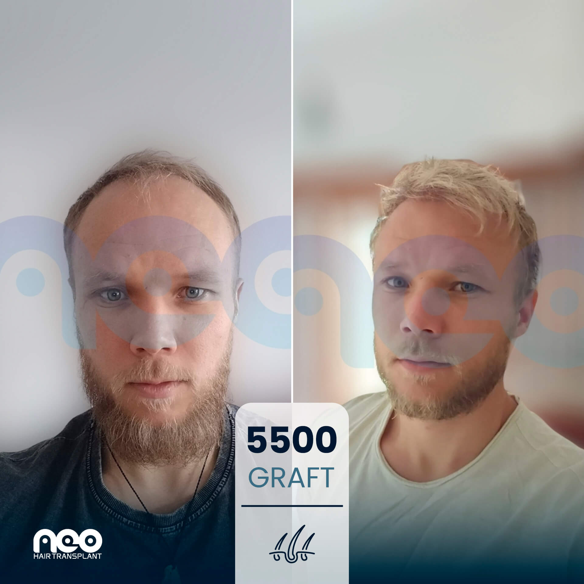 NEO patient hair transplant before and after comparison 2 NEO patient hair transplant before and after comparison 2